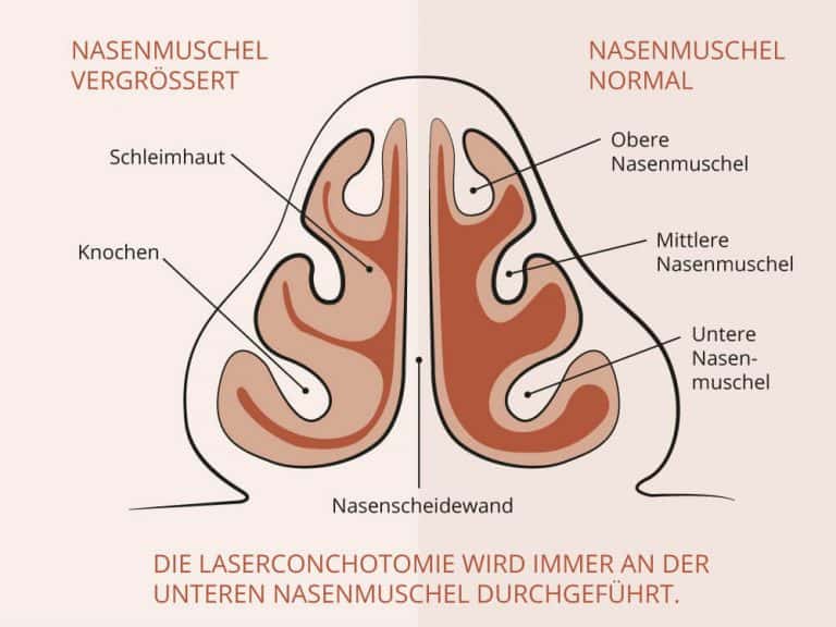 Warum Läuft Die Nase Im Alter Nasenmuschelverkleinerung Frankfurt - HNO Frankfurt